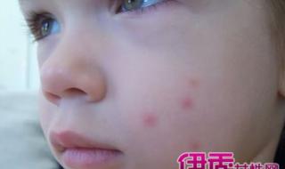 乙肝小红点图片 乙肝小红点图片