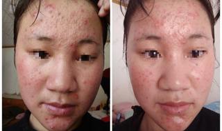 祛痘最好的医院